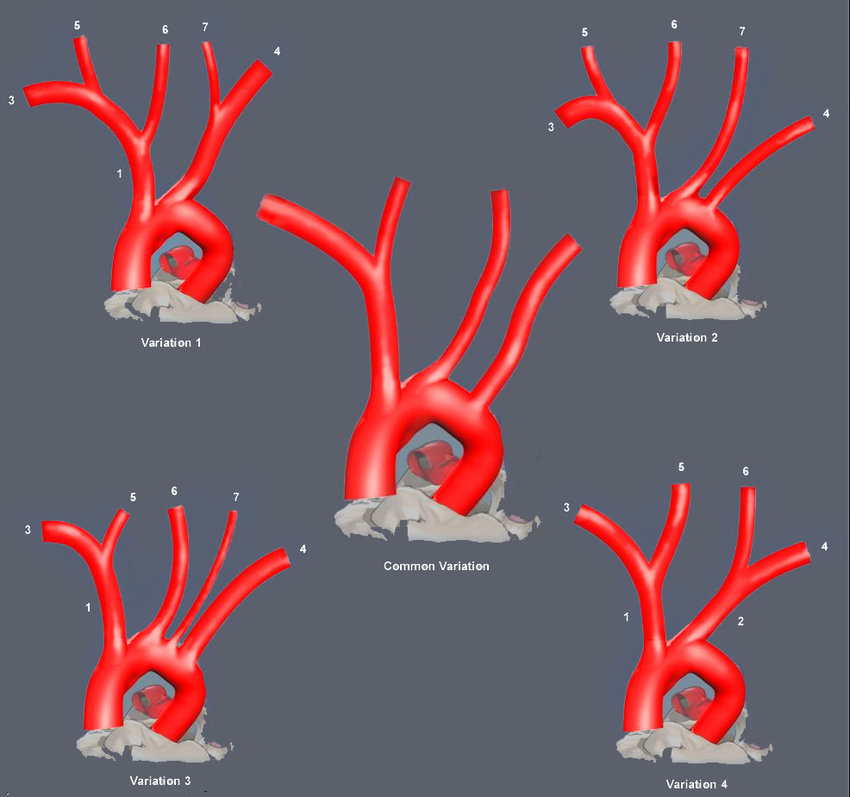 Subclavian artery stenosis